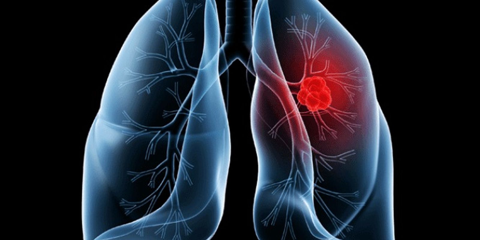 Papa Leão passa por cirurgia para remover nódulo de adenocarcinoma pulmonar